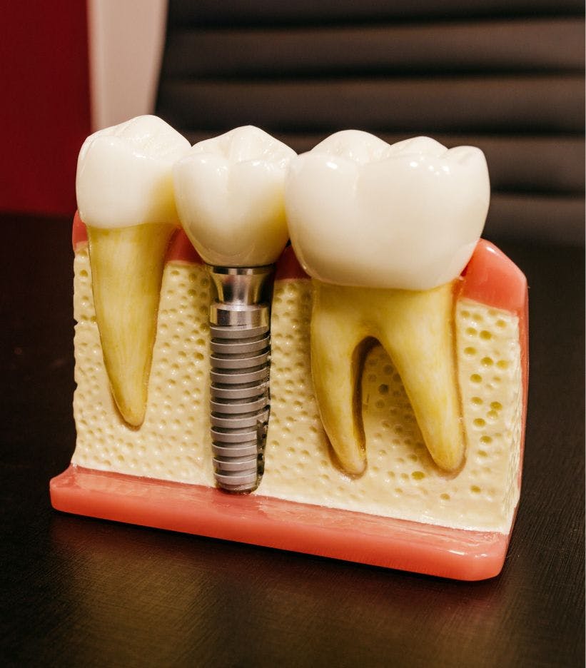 Dental implant physical model