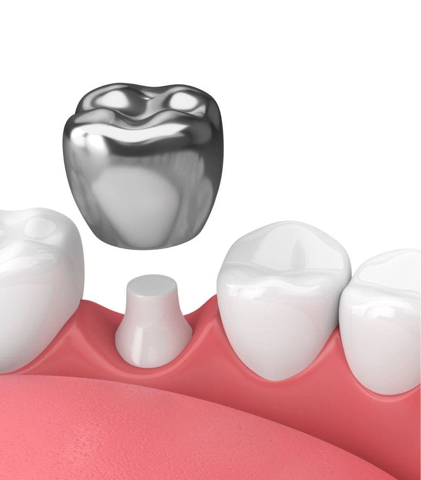3d model of dental crown